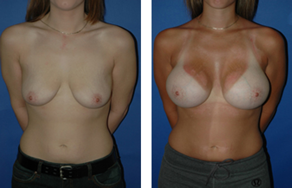 Gummy Bear Breast Implants Before and after photos