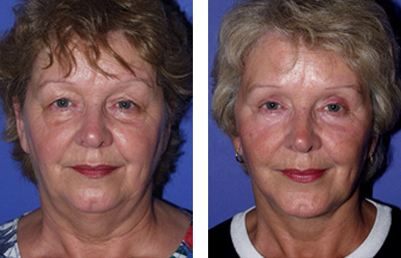 facelift before & after