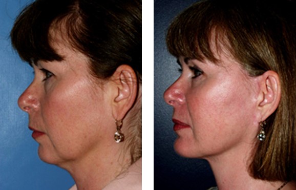 short-scar facelift before & after