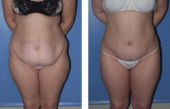 abdominoplasty (tummy tuck) patient