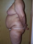 abdominoplasty (tummy tuck) patient