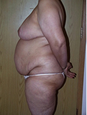 abdominoplasty (tummy tuck) patient