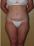 abdominoplasty (tummy tuck) patient