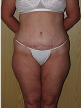 abdominoplasty (tummy tuck) patient