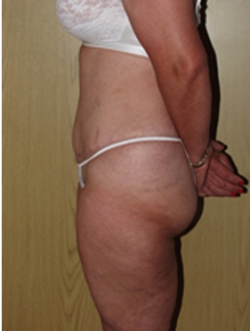 abdominoplasty (tummy tuck) patient