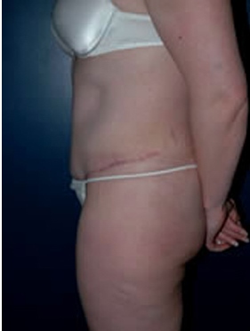 abdominoplasty (tummy tuck) patient