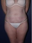 abdominoplasty (tummy tuck) patient