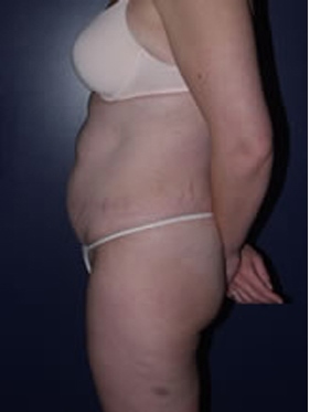 abdominoplasty (tummy tuck) patient