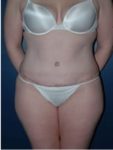 abdominoplasty (tummy tuck) patient