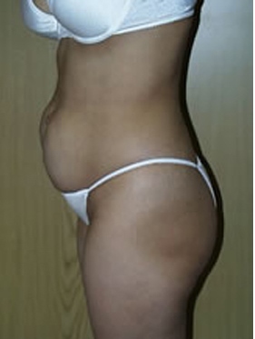 abdominoplasty (tummy tuck) patient