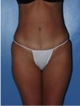 abdominoplasty (tummy tuck) patient
