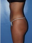 abdominoplasty (tummy tuck) patient