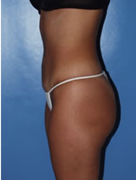abdominoplasty (tummy tuck) patient