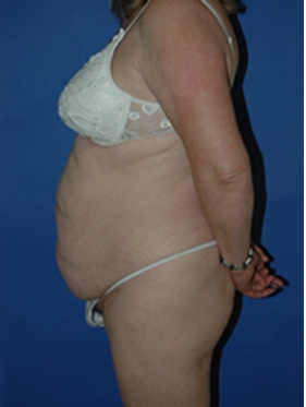 abdominoplasty (tummy tuck) patient