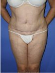 abdominoplasty (tummy tuck) patient