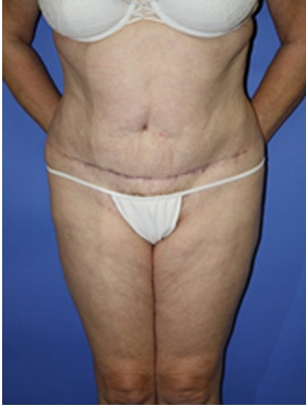 abdominoplasty (tummy tuck) patient