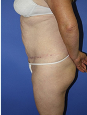 abdominoplasty (tummy tuck) patient