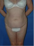 abdominoplasty (tummy tuck) patient