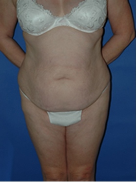 abdominoplasty (tummy tuck) patient