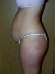 abdominoplasty (tummy tuck) patient