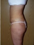 abdominoplasty (tummy tuck) patient