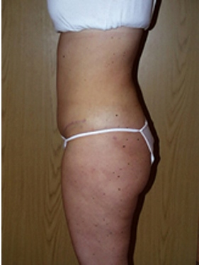 abdominoplasty (tummy tuck) patient