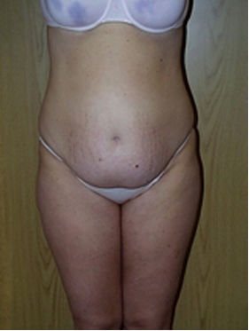 abdominoplasty (tummy tuck) patient