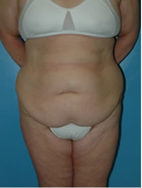 abdominoplasty (tummy tuck) patient