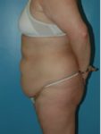 abdominoplasty (tummy tuck) patient