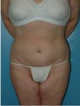 abdominoplasty (tummy tuck) patient