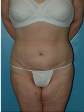 abdominoplasty (tummy tuck) patient