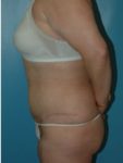 abdominoplasty (tummy tuck) patient