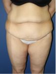 abdominoplasty (tummy tuck) patient