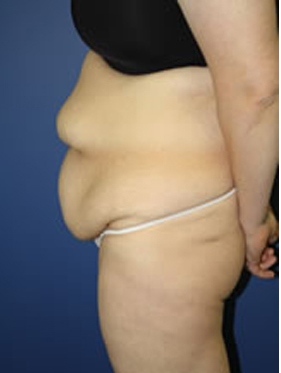abdominoplasty (tummy tuck) patient