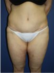 abdominoplasty (tummy tuck) patient