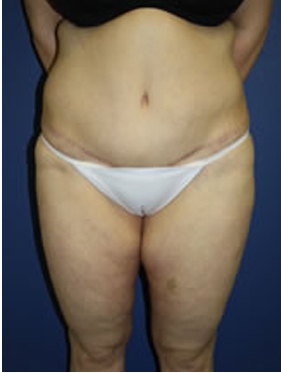 abdominoplasty (tummy tuck) patient