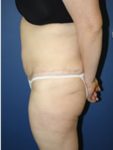 abdominoplasty (tummy tuck) patient