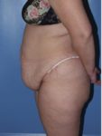abdominoplasty (tummy tuck) patient