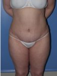 abdominoplasty (tummy tuck) patient