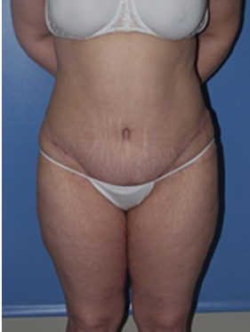 abdominoplasty (tummy tuck) patient