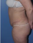 abdominoplasty (tummy tuck) patient