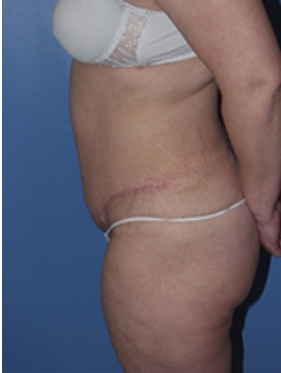 abdominoplasty (tummy tuck) patient