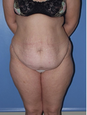 abdominoplasty (tummy tuck) patient