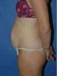 abdominoplasty (tummy tuck) patient