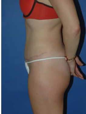 abdominoplasty (tummy tuck) patient