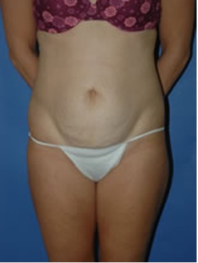 abdominoplasty (tummy tuck) patient