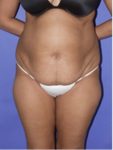 abdominoplasty (tummy tuck) patient