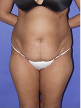 abdominoplasty (tummy tuck) patient