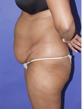 abdominoplasty (tummy tuck) patient