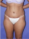abdominoplasty (tummy tuck) patient